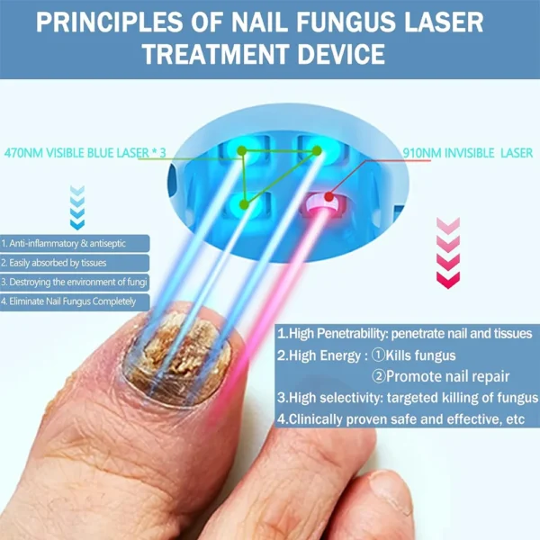 Onychomycosis Treatment Laser Device - Image 3