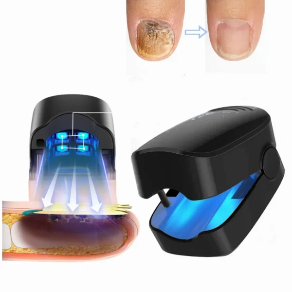 Onychomycosis Treatment Laser Device