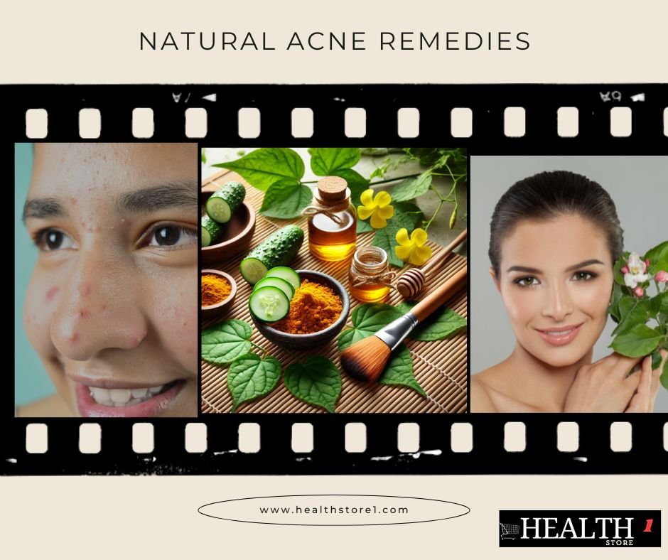 Natural Acne Remedies